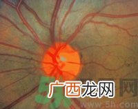 青光眼可以治愈吗？青光眼怎样治疗？