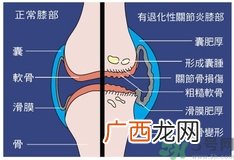 骨关节炎能治好吗？骨关节炎平时注意事项