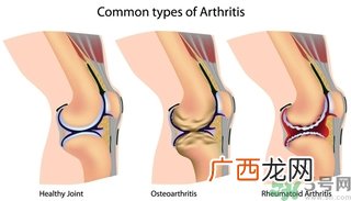 类风湿关节炎的诊断标准类风湿关节炎的饮食选择与禁忌