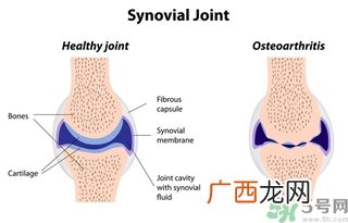 类风湿关节炎的诊断标准类风湿关节炎的饮食选择与禁忌