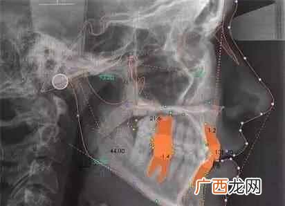 14岁带牙套1-12月变化 矫正牙齿要多少钱