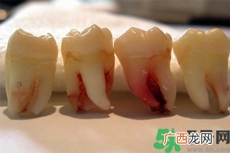 智齿长歪了一定要拔吗？智齿长歪了必须拔吗？