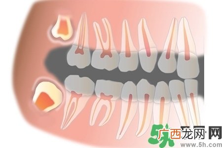 智齿长歪了一定要拔吗？智齿长歪了必须拔吗？