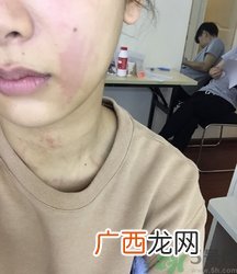 荨麻疹是怎么引起的?荨麻疹有什么症状