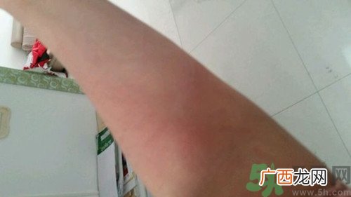 荨麻疹是怎么引起的?荨麻疹有什么症状