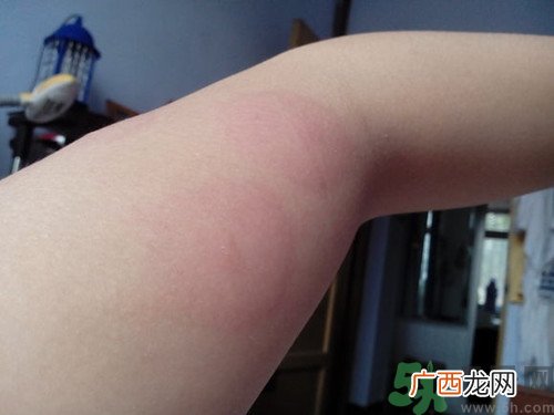 荨麻疹是怎么引起的?荨麻疹有什么症状