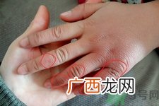 冻疮为什么容易复发？冻疮反复发作怎么办？
