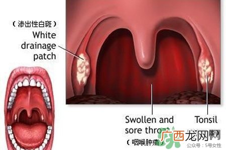 口含大蒜能治疗咽炎吗？巧用大蒜治疗咽炎咳嗽