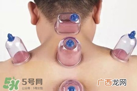冬天拔罐好还是刮痧好？冬天刮痧和拔罐哪个效果好？