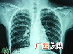 肺炎会传染吗?肺炎吃什么好得快