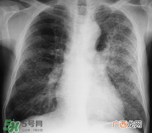 肺炎会传染吗?肺炎吃什么好得快