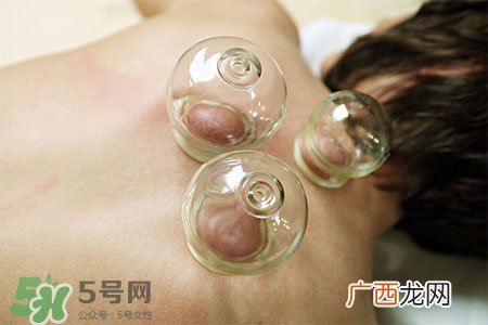 冬天拔罐好吗？冬季最好不要拔火罐