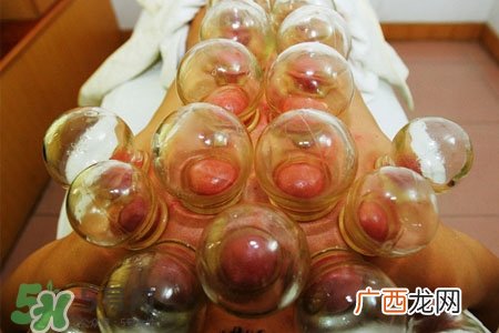 冬天拔罐好吗？冬季最好不要拔火罐