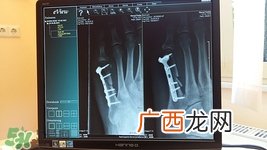 尾椎骨折后怎样恢复的快?尾椎骨折后注意事项