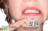上火长痘痘吃什么排毒?上火长痘痘吃什么好?