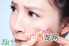 上火长痘痘吃什么排毒?上火长痘痘吃什么好?