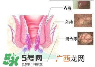 痔疮吃什么药效果好？痔疮吃什么药好得快？