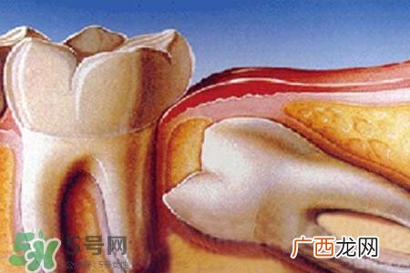 智齿经常发炎怎么办？智齿反复发炎肿痛怎么办？