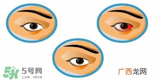 红眼病用什么眼药水好？红眼病吃什么好得快