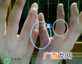 三月份还长冻疮吗？三月份冻疮没好怎么办？