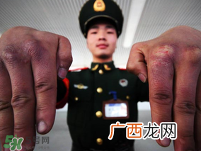 三月份还长冻疮吗？三月份冻疮没好怎么办？