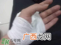 伤口化脓怎么处理？伤口化脓用什么药好？