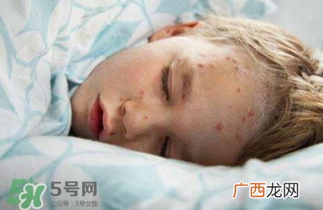 长水痘可以吃鸡蛋吗?得水痘能吃鸡蛋吗?