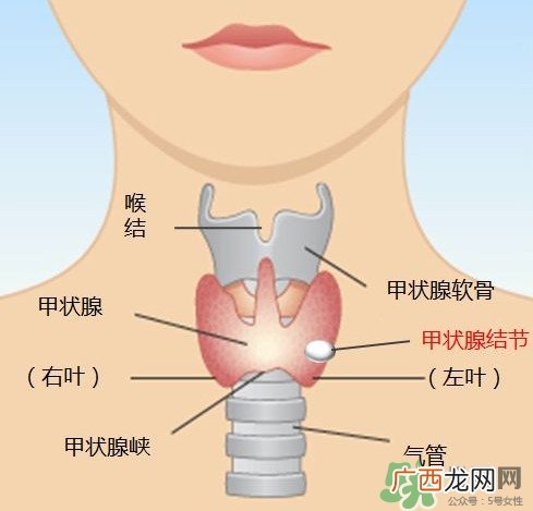 甲状腺结节如何治疗甲状腺结节的症状