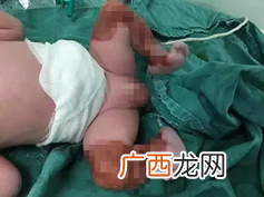 男宝宝双腿透明先天性皮肤缺陷是什么原因