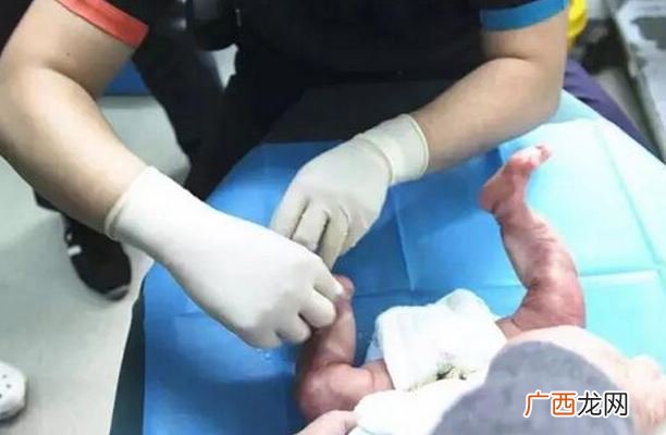 男宝宝双腿透明先天性皮肤缺陷是什么原因
