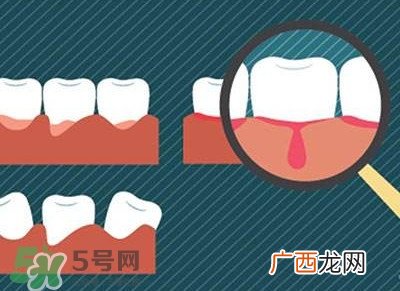 牙龈出血是什么原因？牙龈出血怎么回事