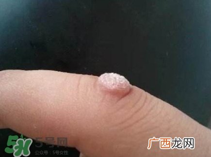 蒲公英可以治刺瘊吗?蒲公英为什么能治瘊子?