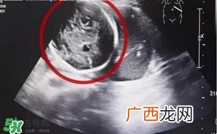 怀孕6月子宫为空腹腔妊娠是什么意思