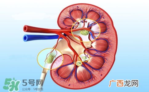 肾结石有什么症状?肾结石原因