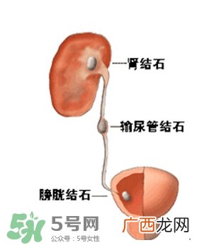 肾结石有什么症状?肾结石原因