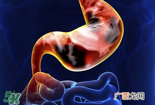 肠胃炎是怎么引起的？肠胃炎的症状及治疗