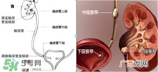 肾结石怎么治最好?肾结石的医治方法