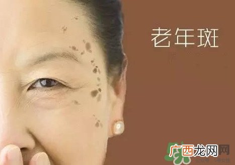 老年斑多大年龄开始有？为什么牙膏能去老年斑？