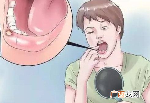 口腔溃疡牙龈肿痛怎么办？口腔溃疡是什么样子