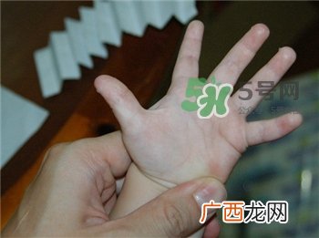 汗疱疹是什么?汗疱疹的治疗