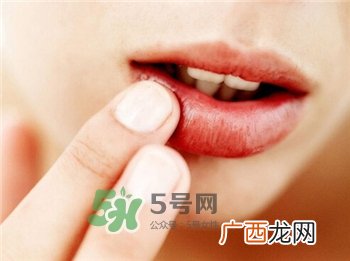 汗疱疹是什么?汗疱疹的治疗