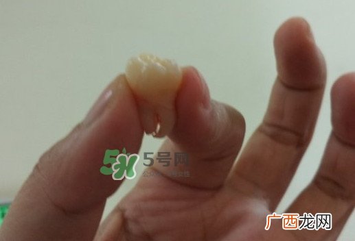 拔智齿痛吗？智齿拔了多久洞会好？