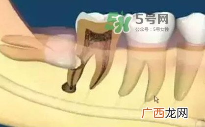 智齿是每个人都会长吗？拔智齿能瘦脸吗？