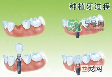 种植牙费用多少钱？国产种植牙价格