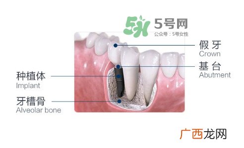种植牙费用多少钱？国产种植牙价格