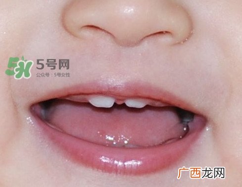 牙齿缝隙大怎么办？牙缝大带牙套有用吗