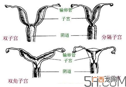 子宫畸形有哪些？子宫畸形有什么影响？