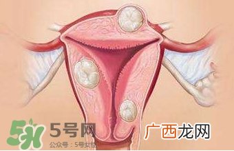 双子宫可以上环吗?双子宫上环要注意哪些?