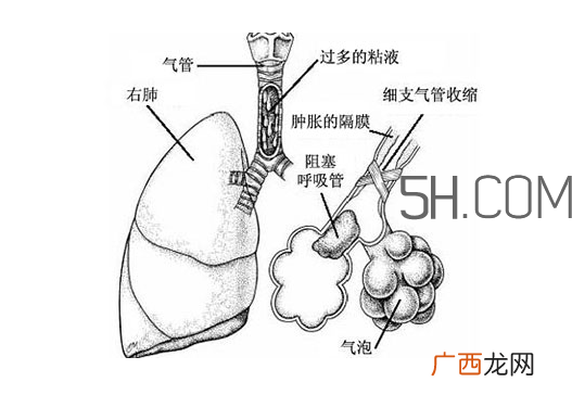 哮喘是怎么引起的?哮喘是什么感觉?