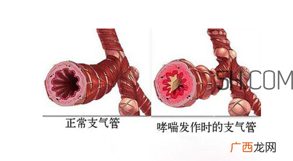 哮喘应该看什么科?哮喘应该吃什么药?